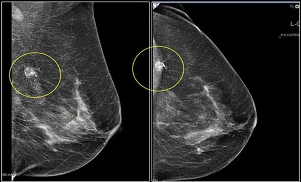 Объемная маммография